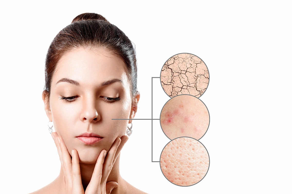 woman with skin blemishes